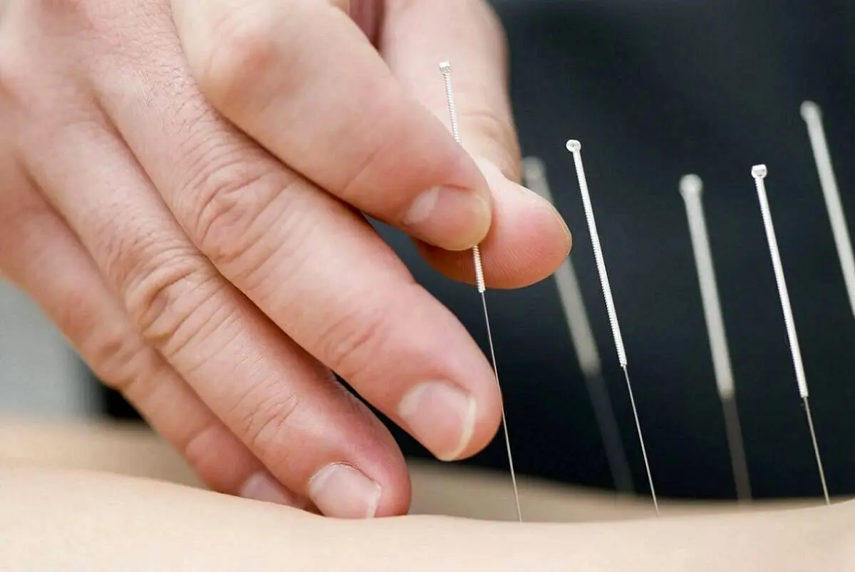 طب سوزنی خطر سکته مغزی را کاهش می‌دهد؟