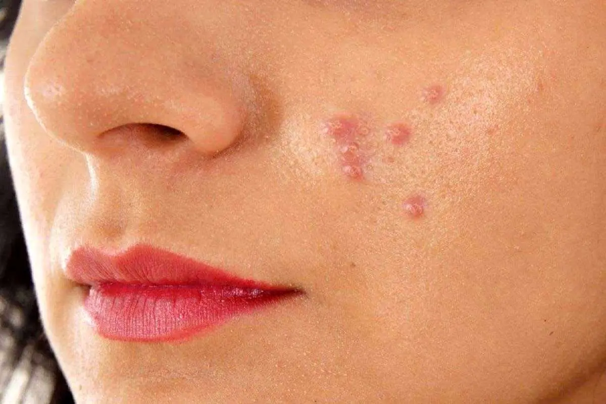 با این خوراکی‌ها جوش‌های صورت را درمان کنید