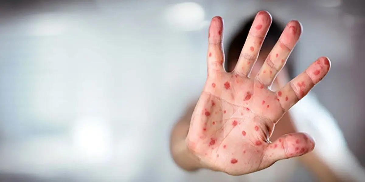 افزایش موارد ابتلا به سرخک در جهان