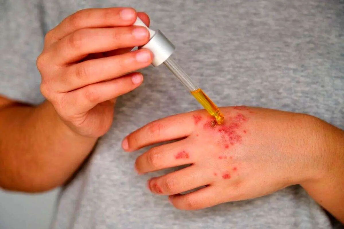 شناسایی، مراقب و درمان اگزما طبق گفته یک متخصص پوست