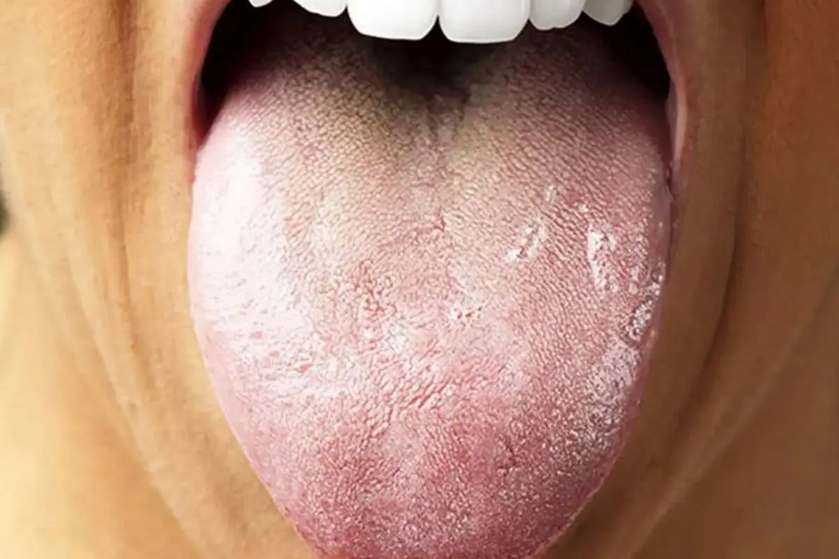 علت سفیدی زبان چیست؟