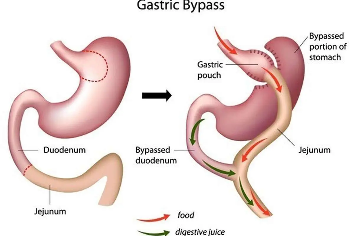 هماهنگی و تناسب اندام با روش های پیشرفته بای پس معده و اسلیو معده