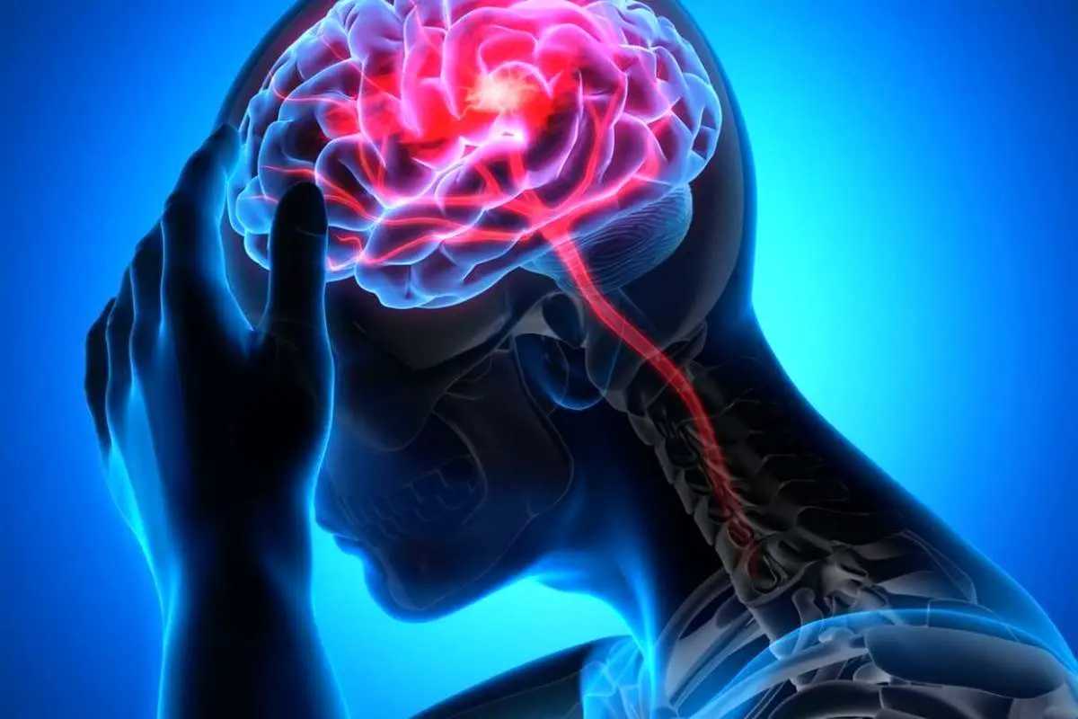 علائم سکته مغزی چیست؟