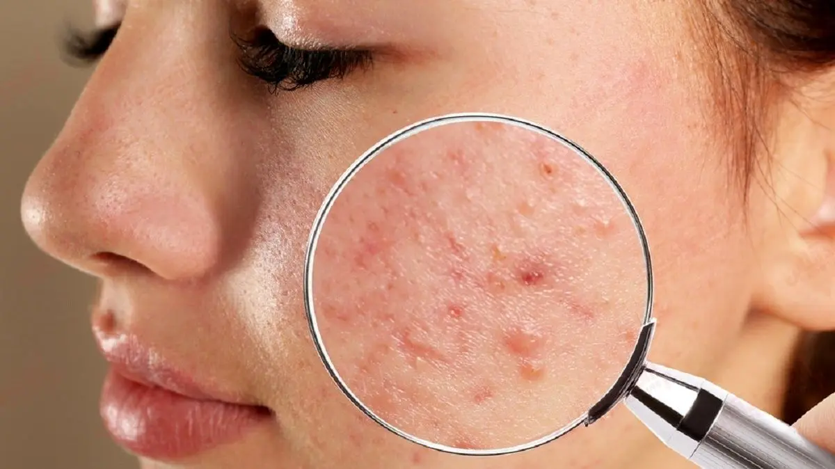 چه بخوریم که جوش نزنیم؟
