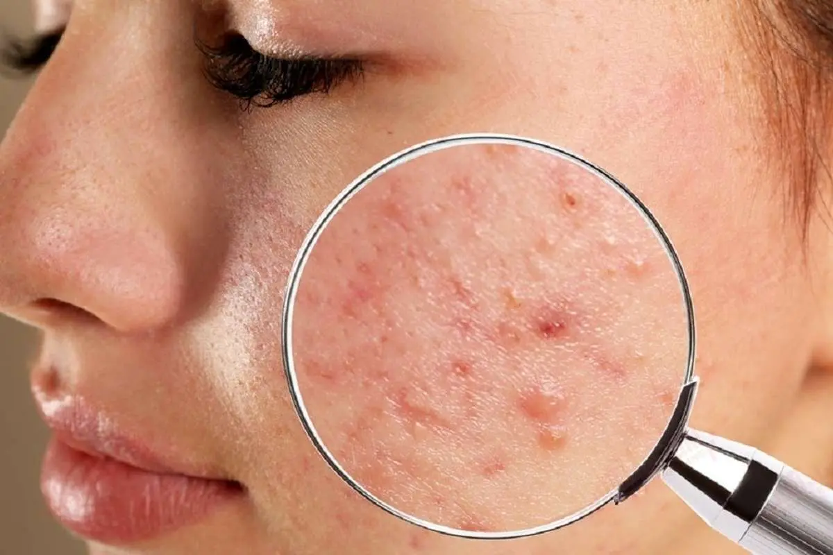 چه بخوریم که جوش نزنیم؟