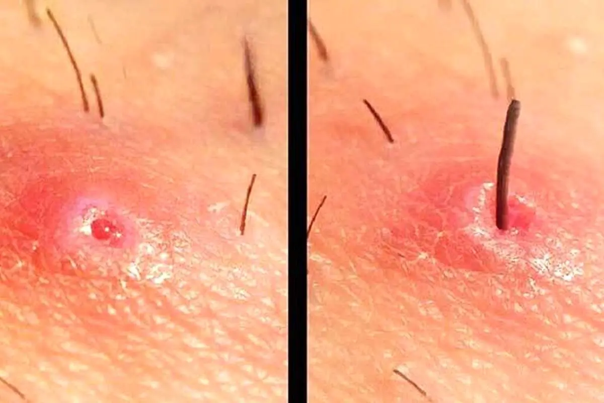 راهنمای درمان خانگی کیست مویی