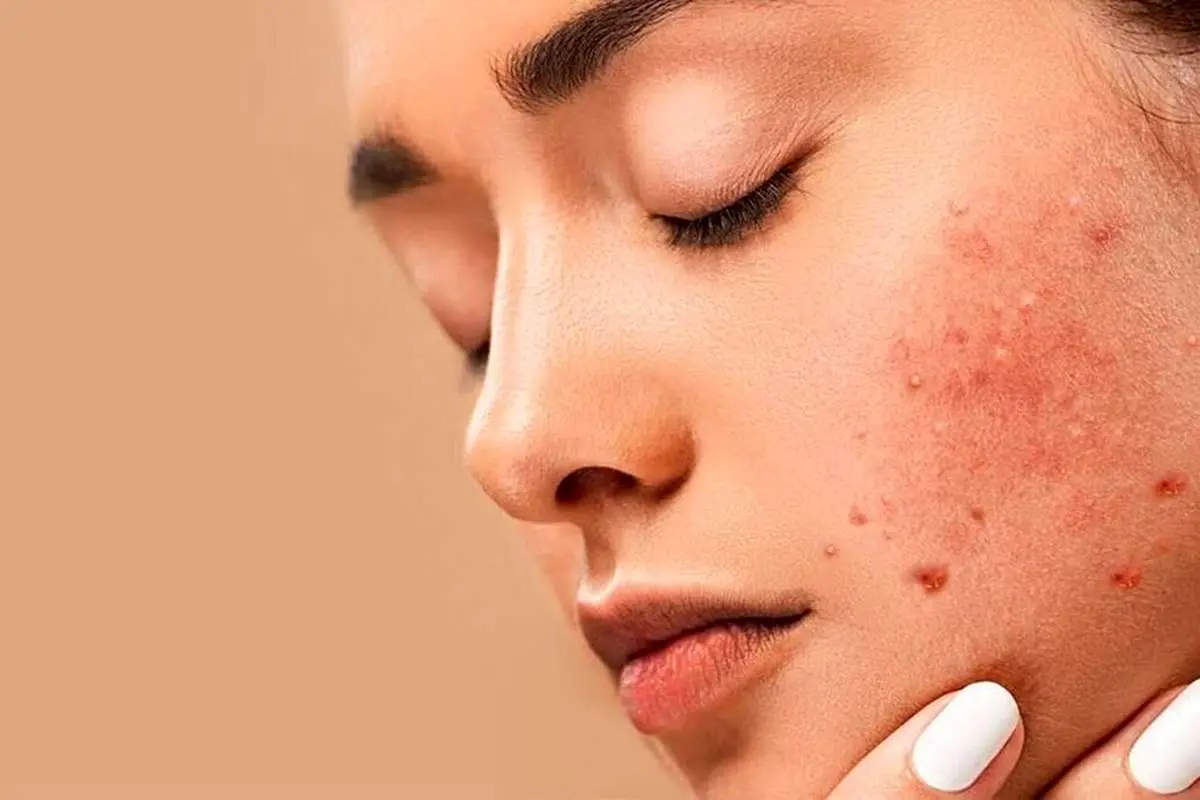 آکنه بالای ۵۰ سالگی؟ در اینجا نحوه خلاص شدن از شر لکه‌های پوستی دوره یائسگی آمده است