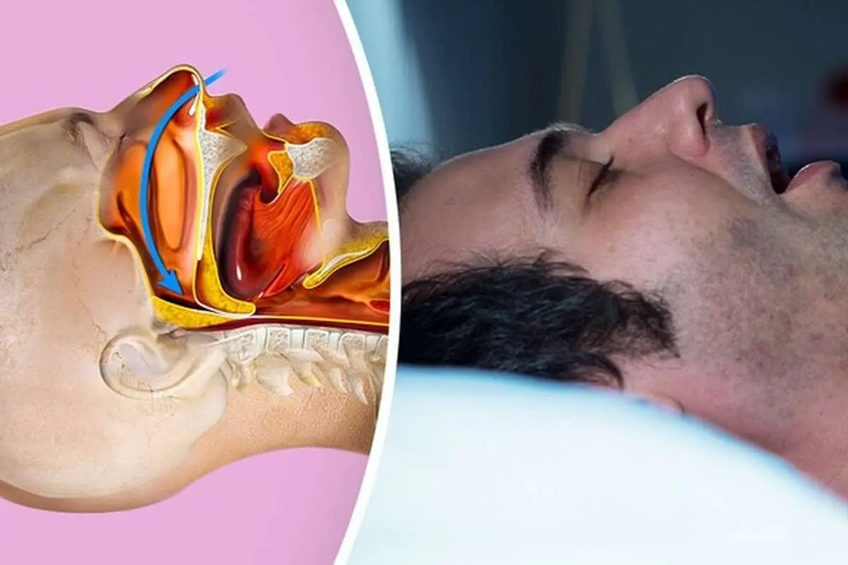 چند راهکار ساده خانگی برای حل مشکل خروپف