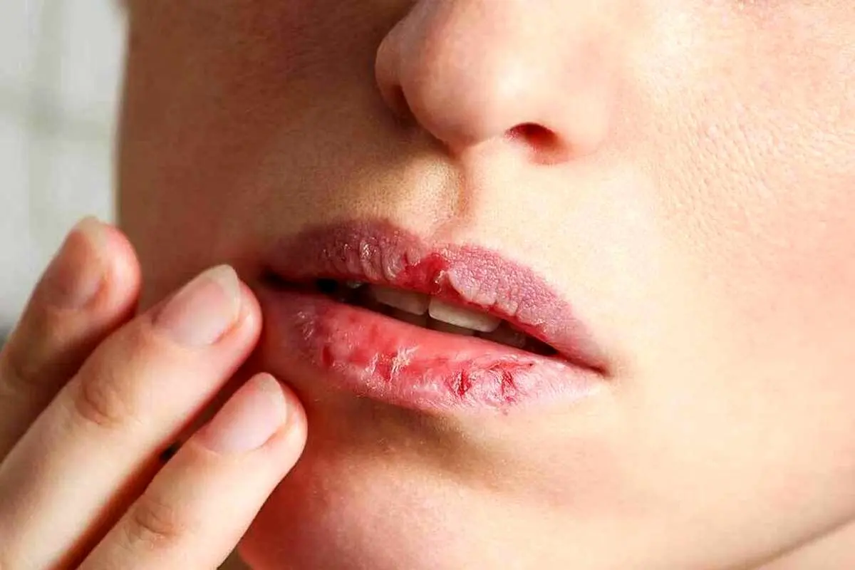 ۴ دلیل ترک خوردن لب‌ها و روش‌های درمان