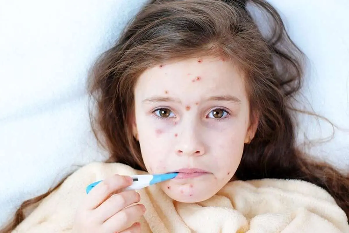 آبله یک تهید برای جهان؟