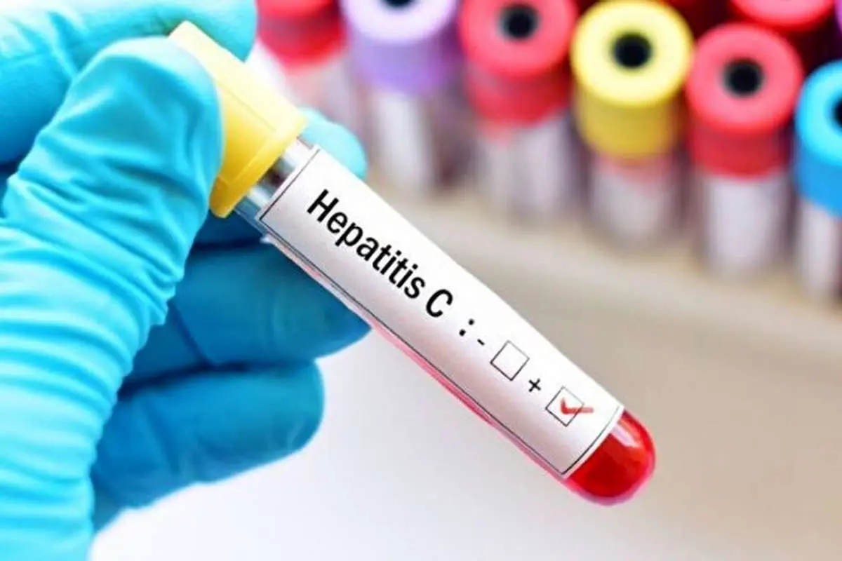 درمان رایگان بیماران هپاتیت C؟