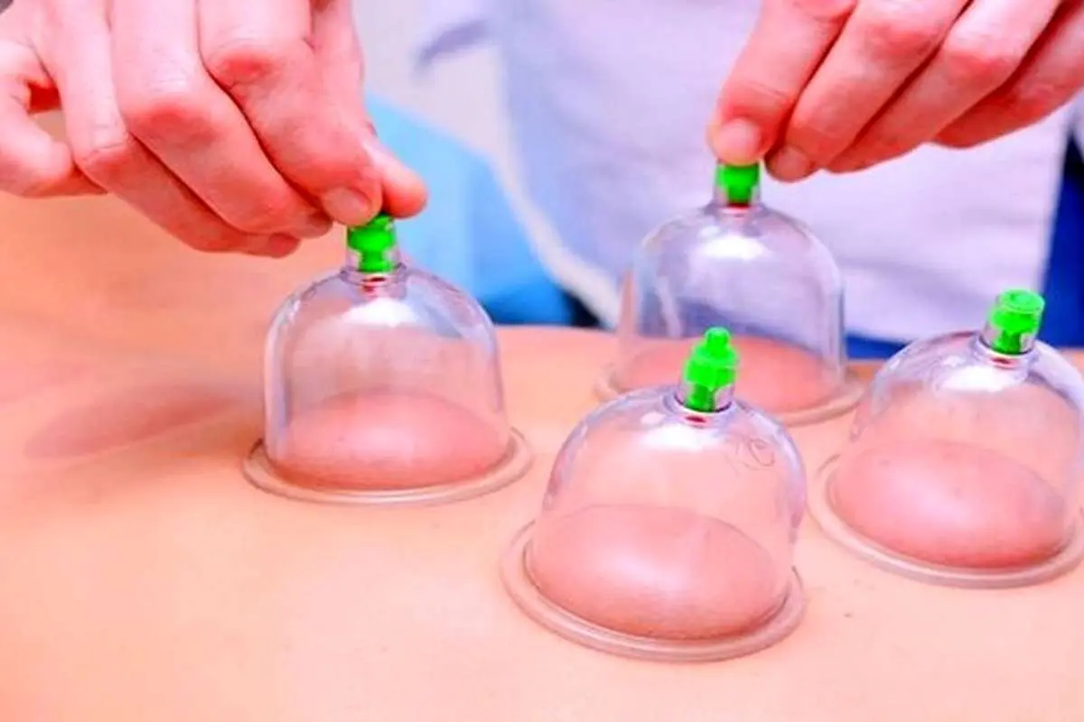 (ویدئو) تفاوت بین بادکش و حجامت