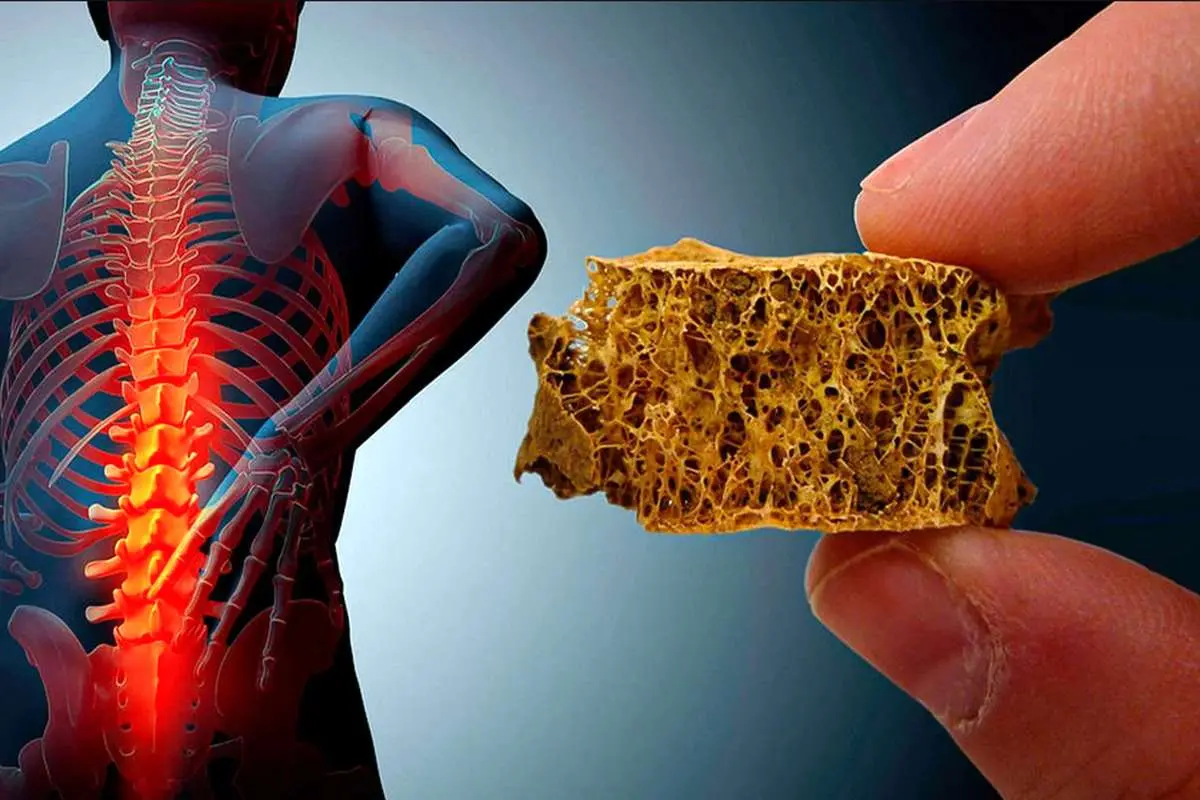 راهکار‌های داشتن استخوان‌های قوی