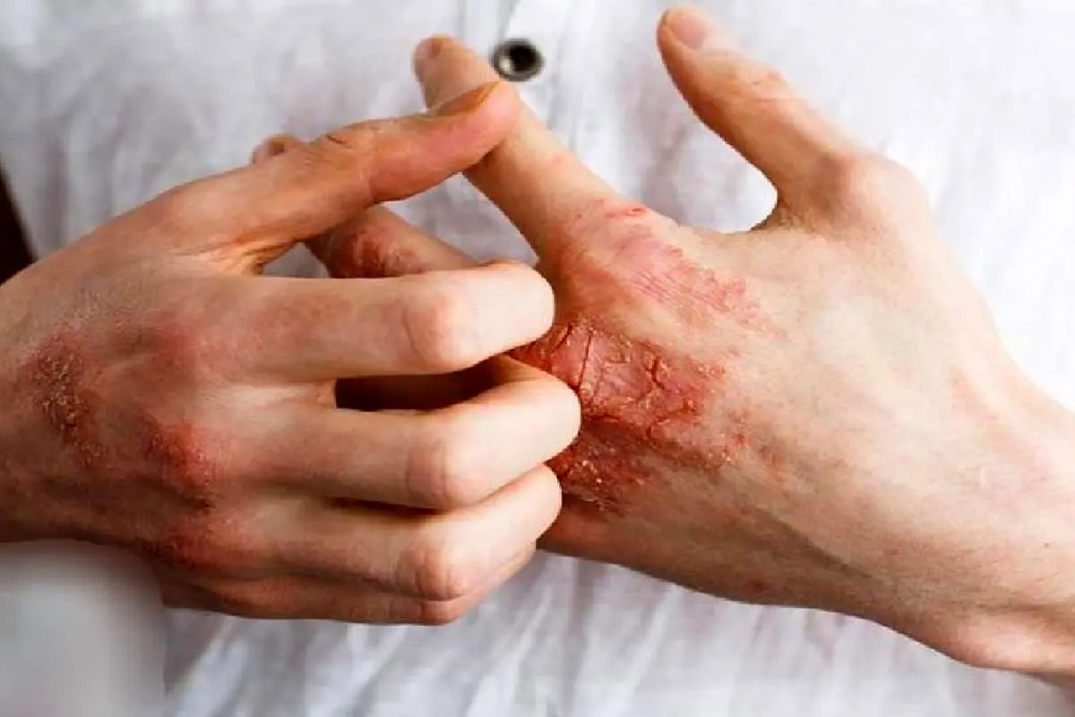 بیماری سلیاک چه علایمی دارد؟