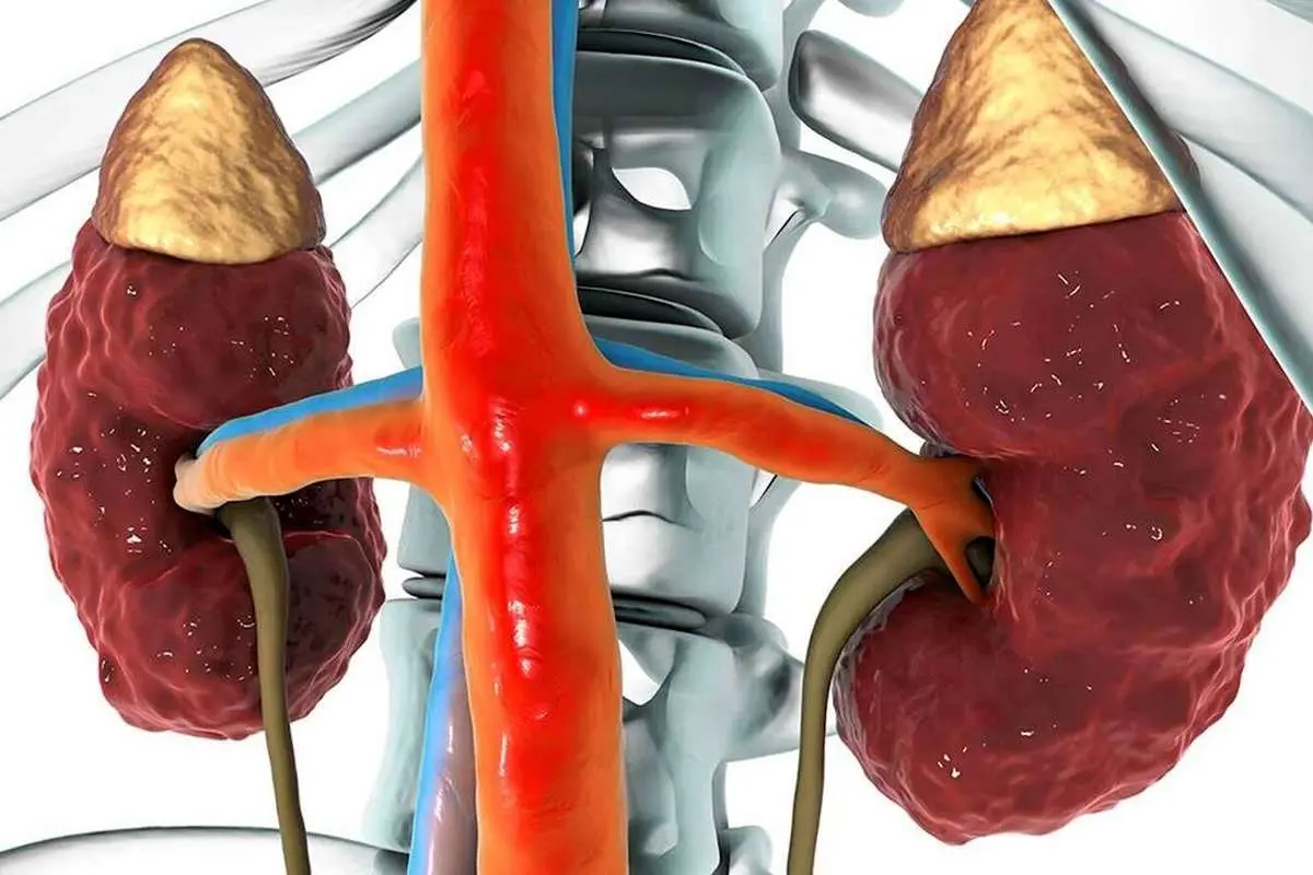 ۸ علت ابتلا به بیماری‌های کلیوی