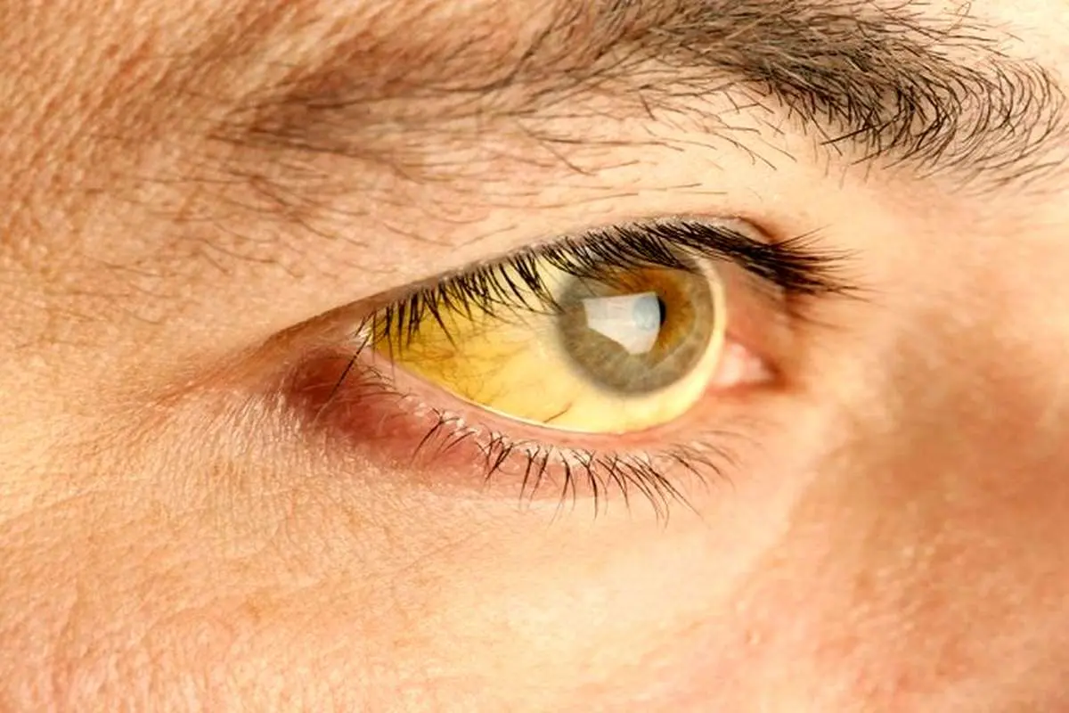 بیماری تب زرد؛ علائم آن را بشناسید!