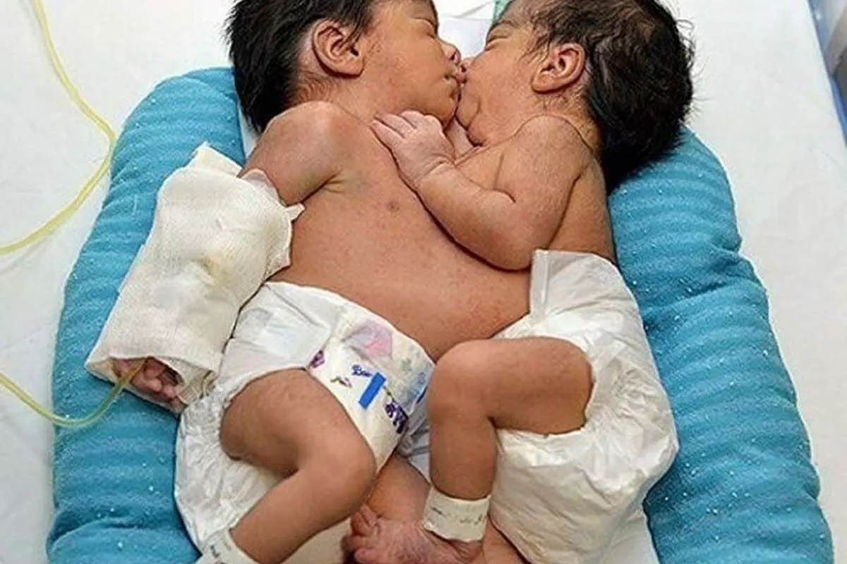 دوقلو‌های بهم چسبیده اهوازی از هم جدا شدند