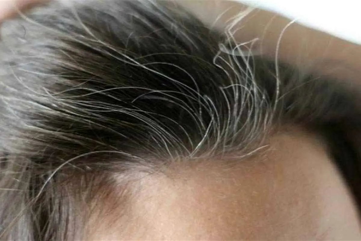 ۵ علت مهم سفید شدن مو