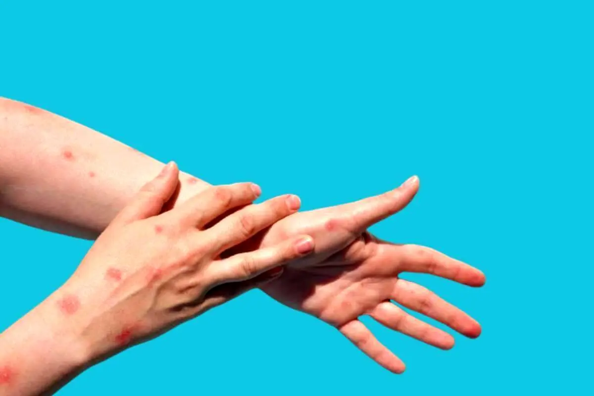 آژیر قرمز آبله میمون به صدا درآمد