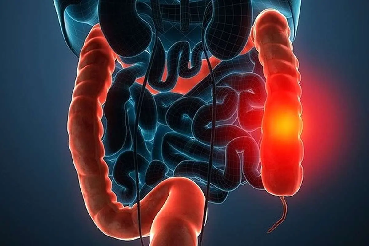 سرطان روده بزرگ بر عملکرد کدام قسمت‌ها تأثیرگذار است؟