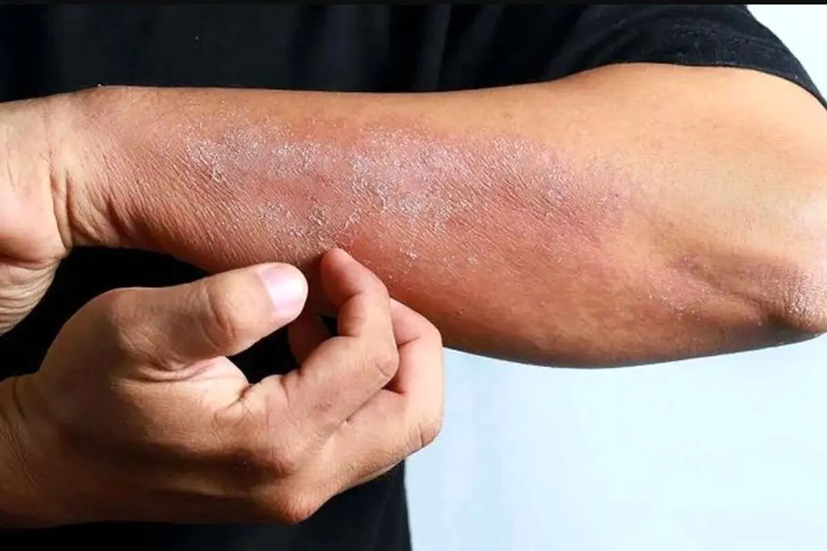 (ویدئو) ابتلا به سرطان پوست با قرار گرفتن در معرض آفتاب ساعت ۱۰ تا ۱۶