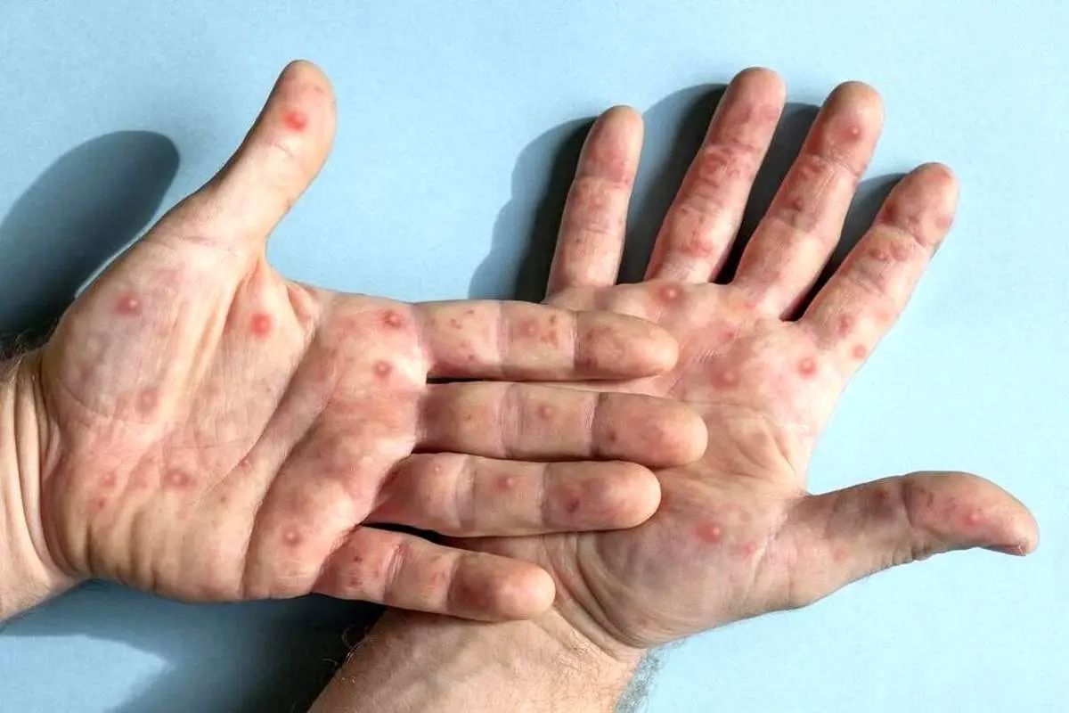 اظهارات نگران‌کننده وزارت بهداشت درباره نحوه انتقال آبله میمونی