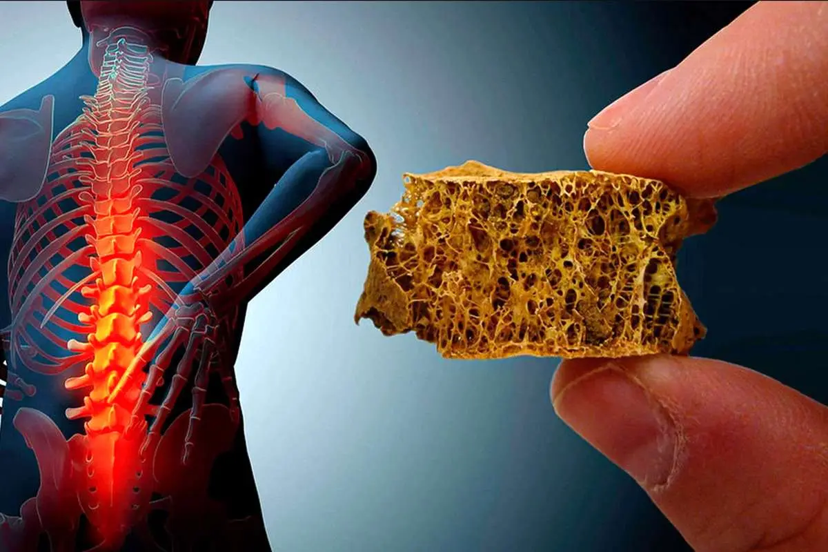 این افراد بیشتر از دیگران دچار پوکی استخوان می‌شوند