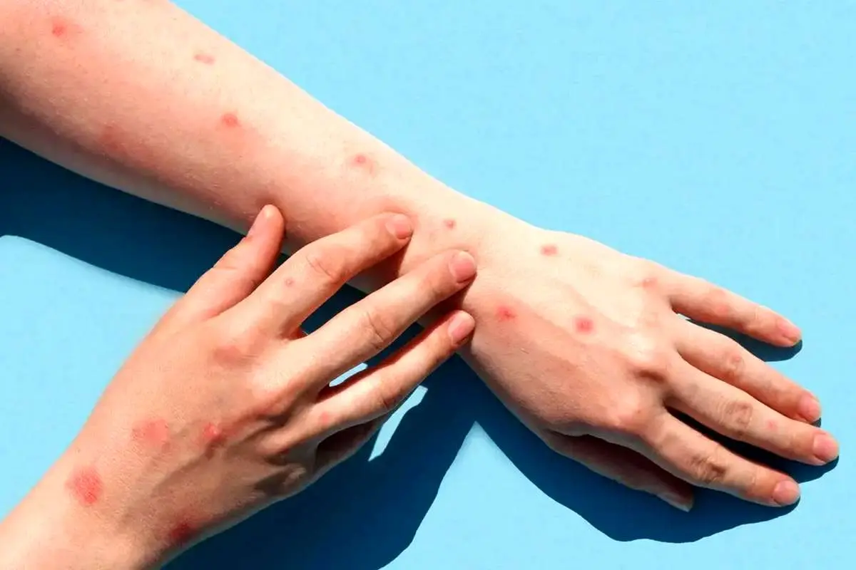 عضو کمیسیون بهداشت: نگران نباشید! هیچ موردی از آبله میمونی در کشور شناسایی نشده است