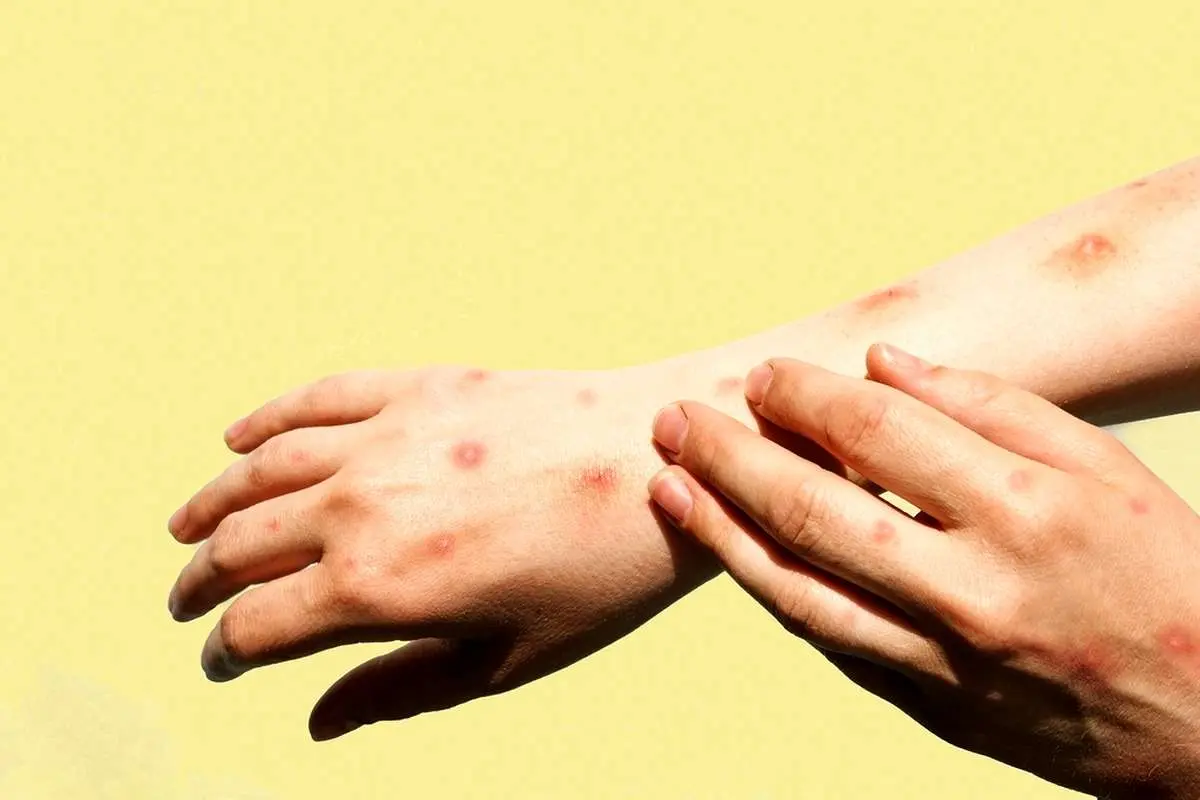 مینو محرز: یک سال‌ونیم پیش بیمار مبتلا به آبله میمونی داشتم