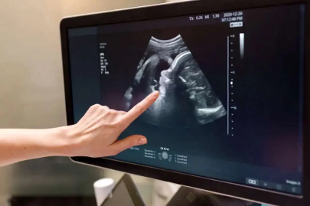 شناسایی یک سندرم نادر ژنتیکی در جزیره قشم؛ حذف غربالگری بازهم قربانی گرفت