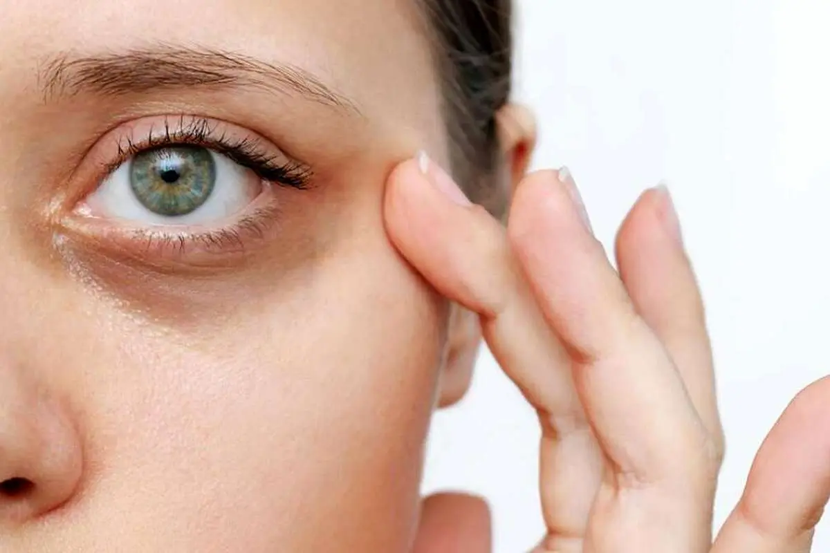 بهترین درمان‌ها برای از بین بردن سیاهی زیر چشم