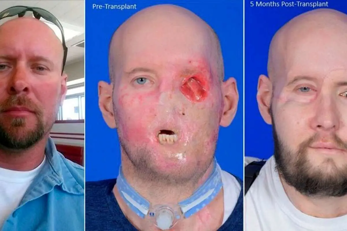 موفقیت پیوند کامل چشم و صورت روی یک کهنه سرباز آمریکایی