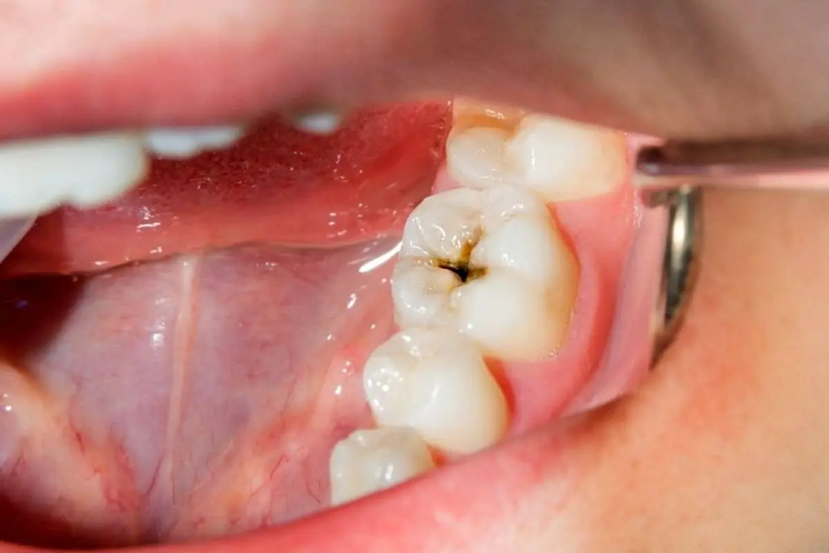 نوشیدنی‌ای که دندان سالم برای‌تان نمی‌گذارد