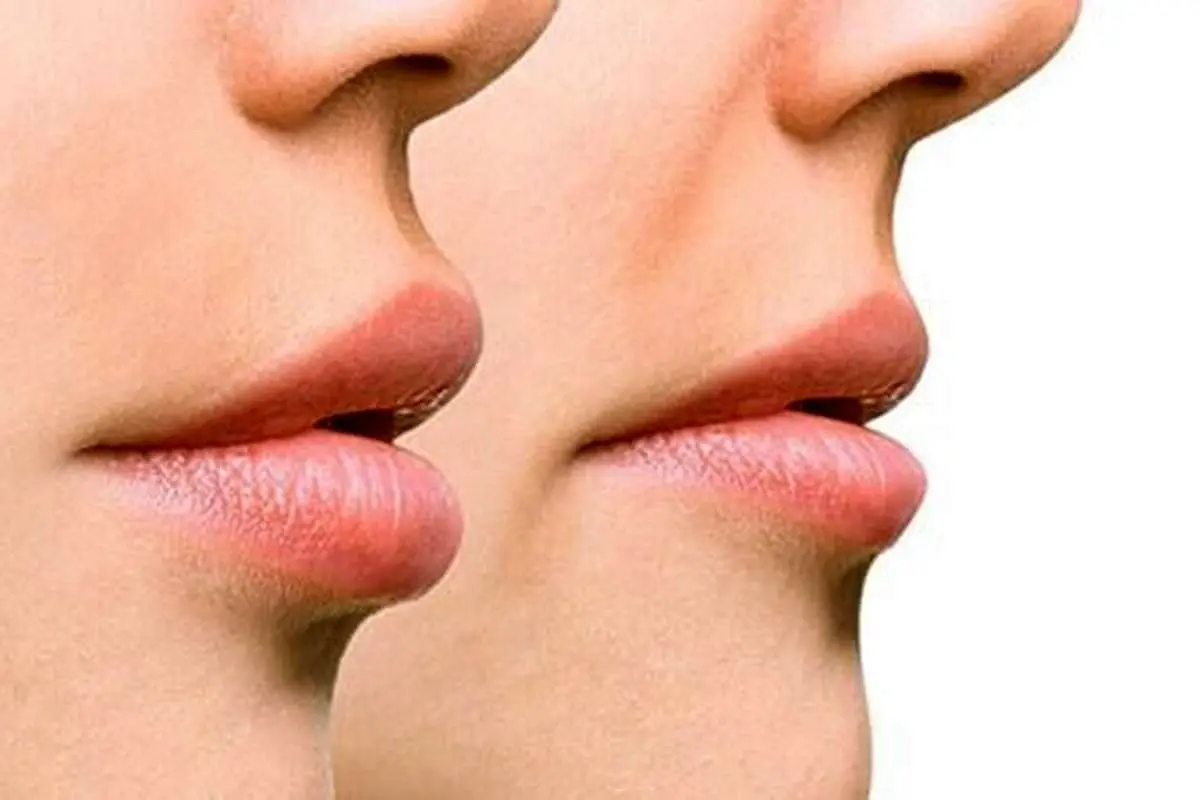 ایرانی‌ها برای این عمل زیبایی ۱۵۰ میلیون می‌دهند