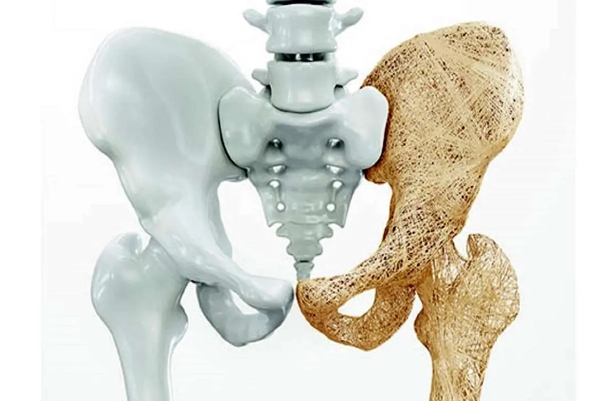 (ویدئو) راهکار‌های درمانی پوکی استخوان در طب سنتی