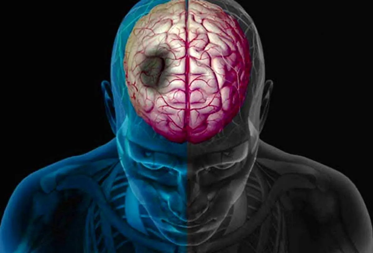 چه کار کنیم که دچار سکته مغزی نشویم؟ (اینفوگرافی)