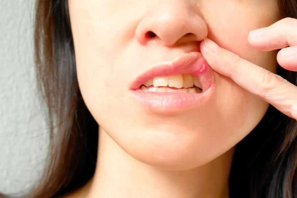 علل بروز آفت‌های مکرر دهان (ویدئو)