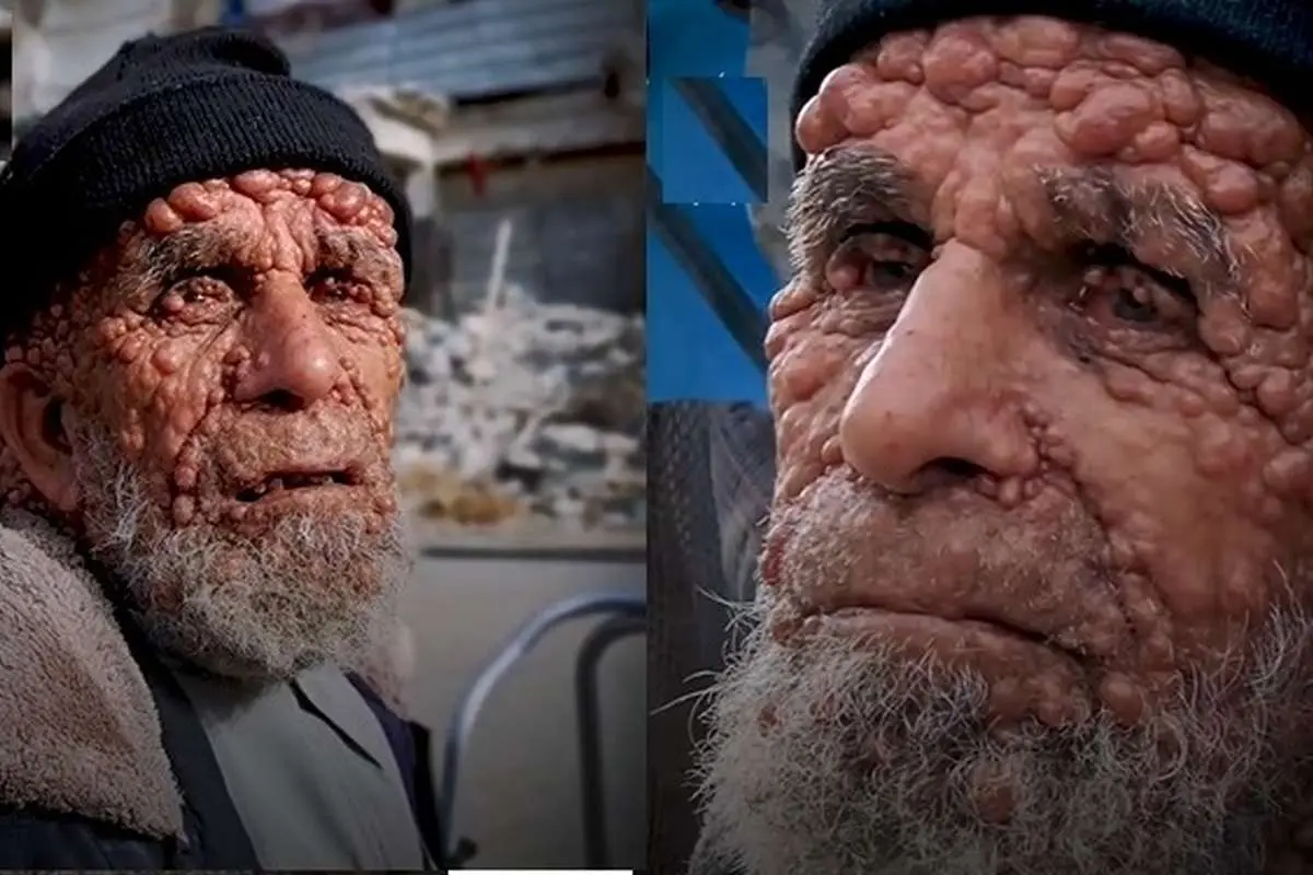 (ویدئو) بیماری پوستی پیرمرد فلسطینی را بلعیده است!