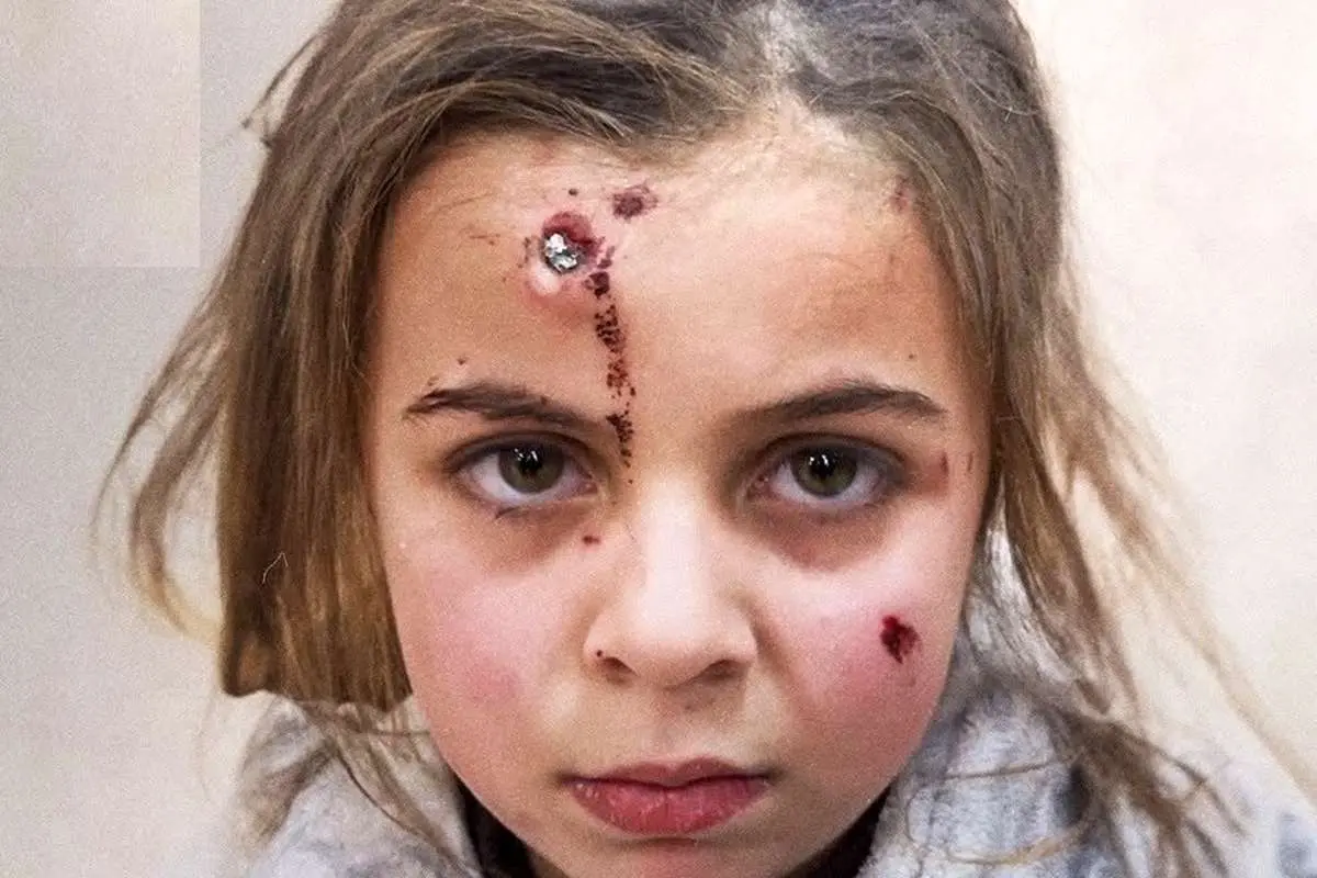 (ویدئو) خونسردی عجیب دختربچه فلسطینی با ترکش در پیشانی