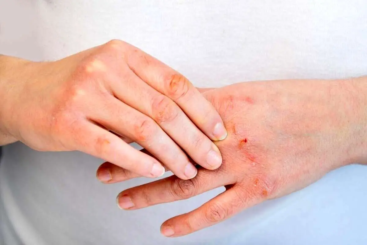 چگونه از خشکی پوست در زمستان جلوگیری کنیم؟