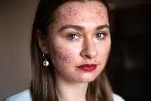 ۱۶ کار رایجی که در واقع باعث آسیب شدید به پوست صورت می‌شوند