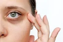 چرا دور چشم بعضی‌ها همیشه تیره است؟!