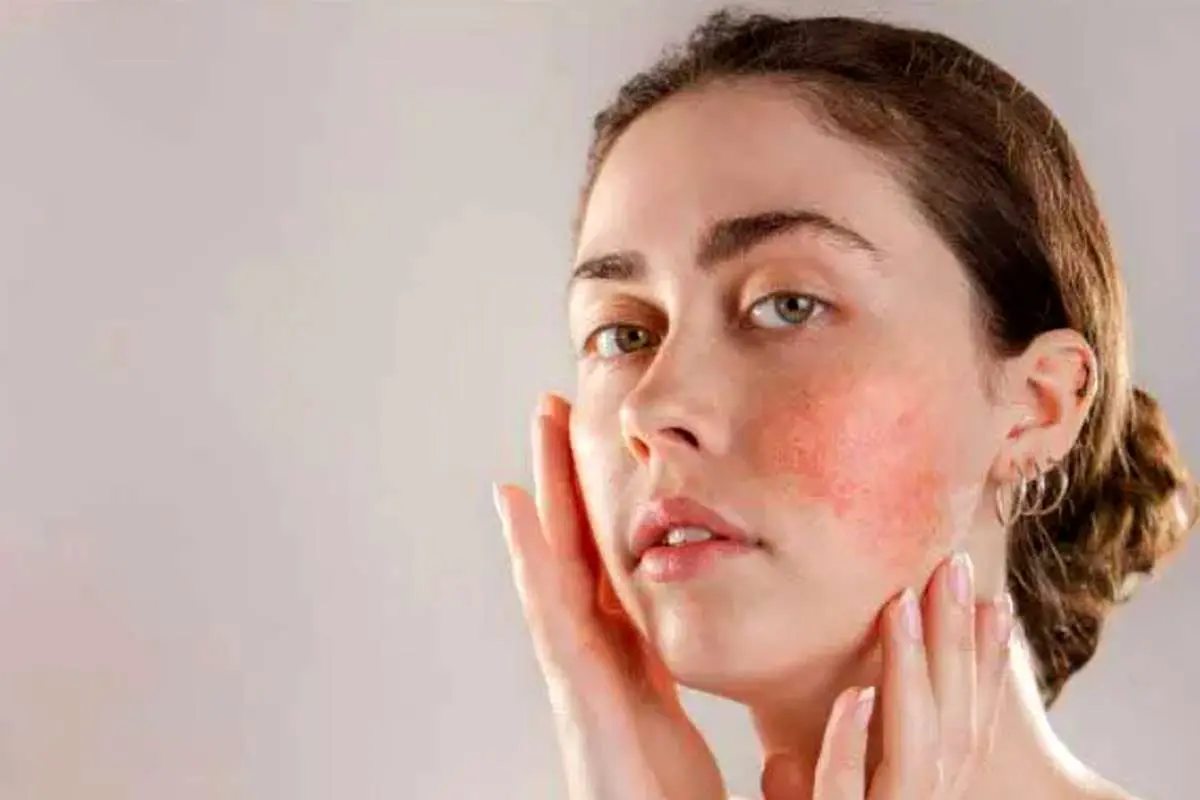 لکه‌های قرمز روی پوست نشانه کمبود کدام ویتامین است؟