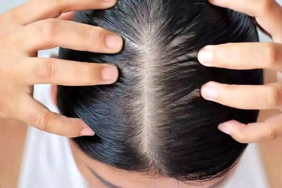 کمبود این ویتامینها باعث ریزش موهای سر میشود