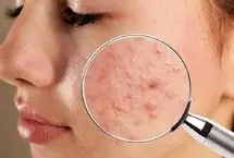 برای مبارزه با آکنه، به دنبال این «پنج ماده» در کرم‌ها باشید