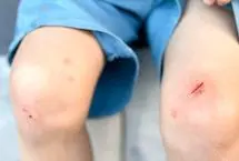 وقتی کبودی ساده می‌تواند فاجعه‌بار باشد