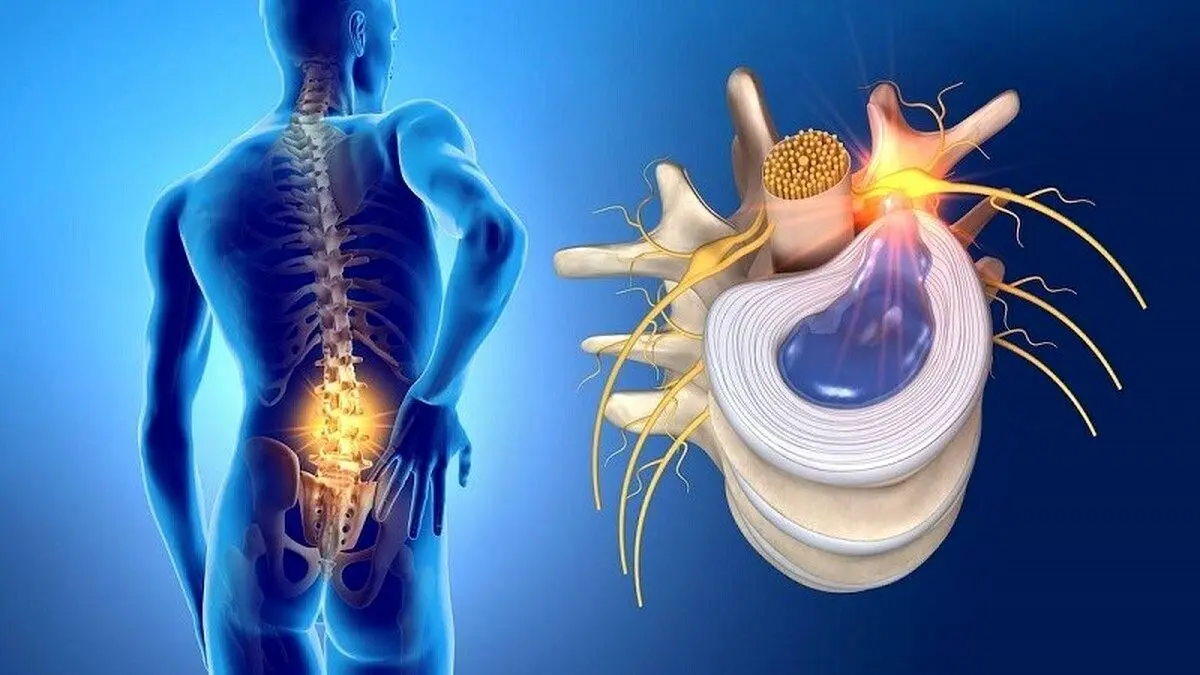 دیسک کمر دارید؟ این ۵ اشتباه را هرگز تکرار نکنید!