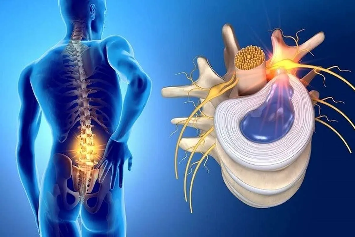 دیسک کمر دارید؟ این ۵ اشتباه را هرگز تکرار نکنید!