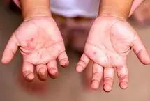 شیوع یک بیماری واگیردار در ایران