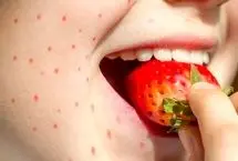 علایم حساسیت به توت فرنگی